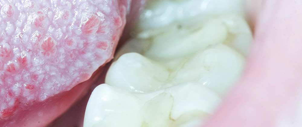 orale Mucositis